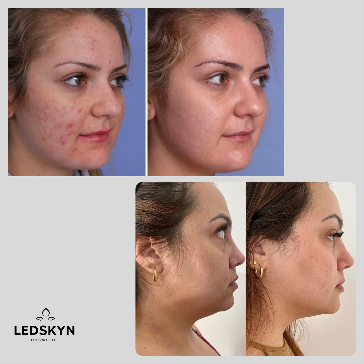LumiLed 7 en 1 – LedSkyn